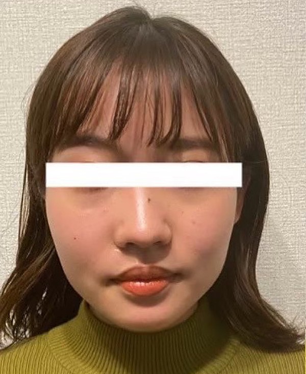 施術前